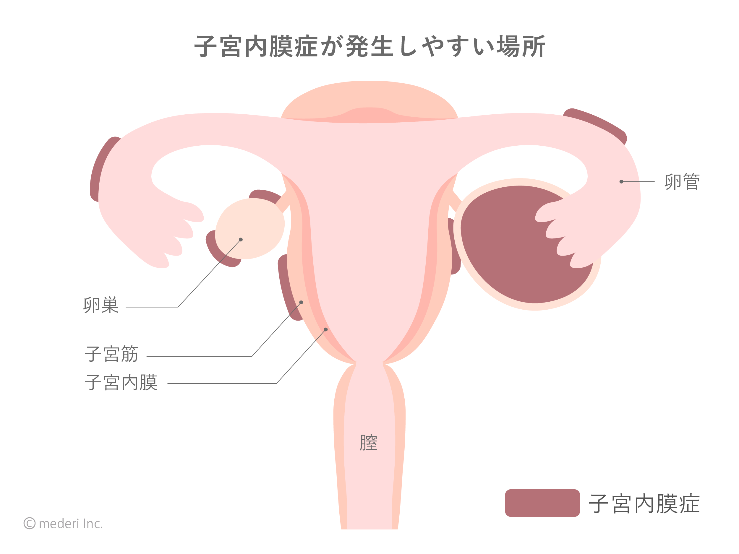 子宮内膜症が発生しやすい場所の画像