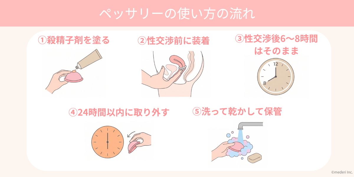 ペッサリーの使い方の流れのイメージ