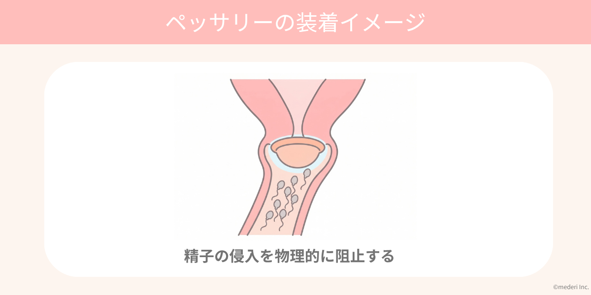ペッサリーの装着イメージのイメージ