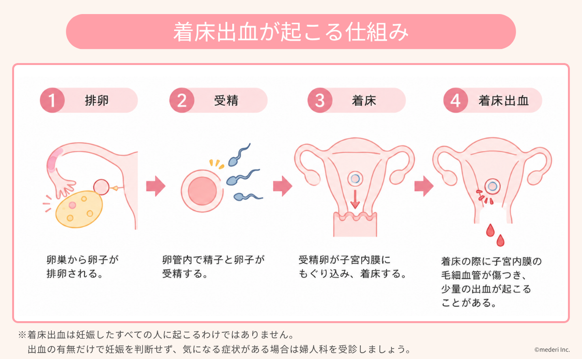 着床出血が起こる仕組みのイメージ