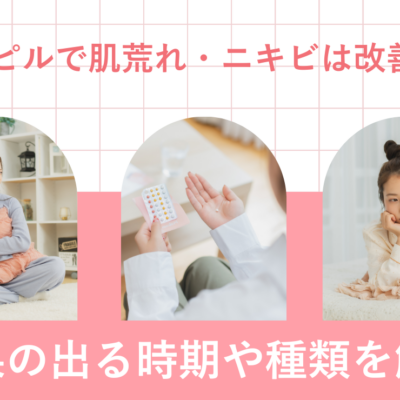 低用量ピルで肌荒れ・ニキビは改善する？効果の出る時期や種類を解説